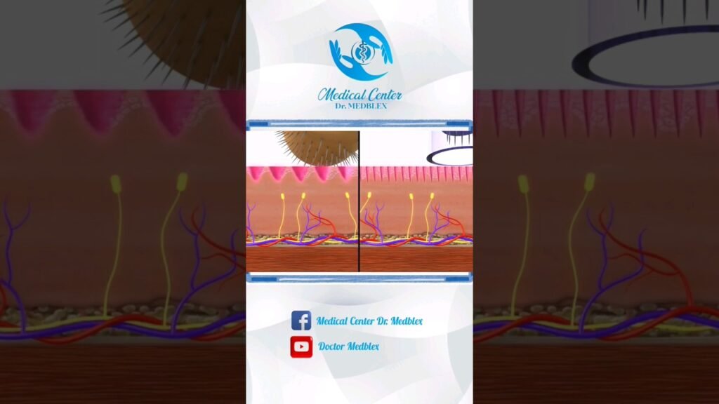 Cómo combinar minoxidil en la parte superior del cráneo con dermaroller sin dañar la piel