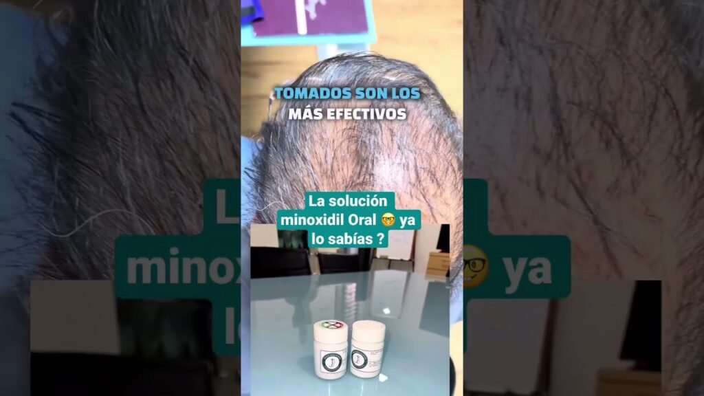 Cómo saber si el minoxidil está causando más caída de alopecia androgénica