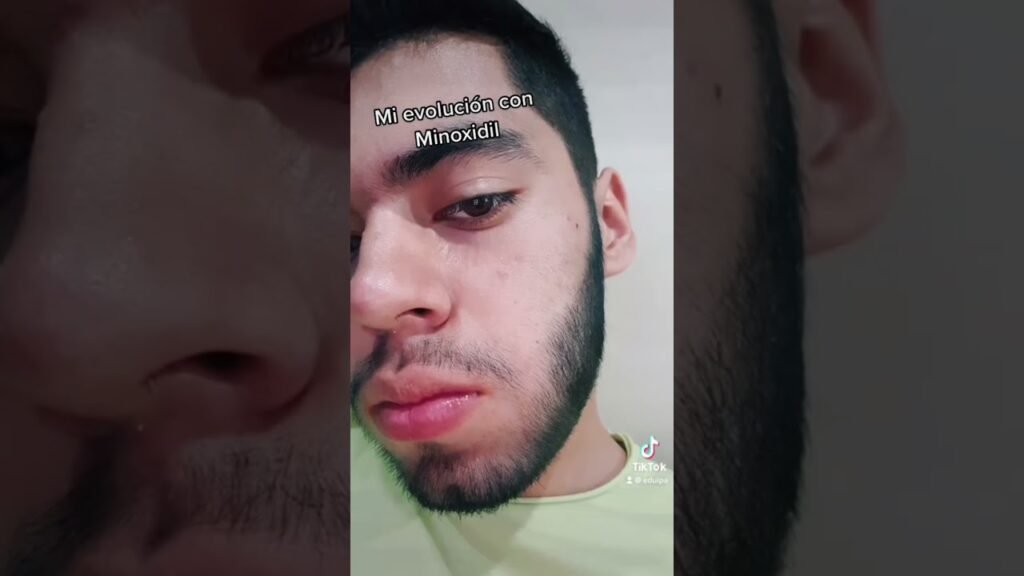 Qué aprendí tras un año usando minoxidil en la historia inspiradora