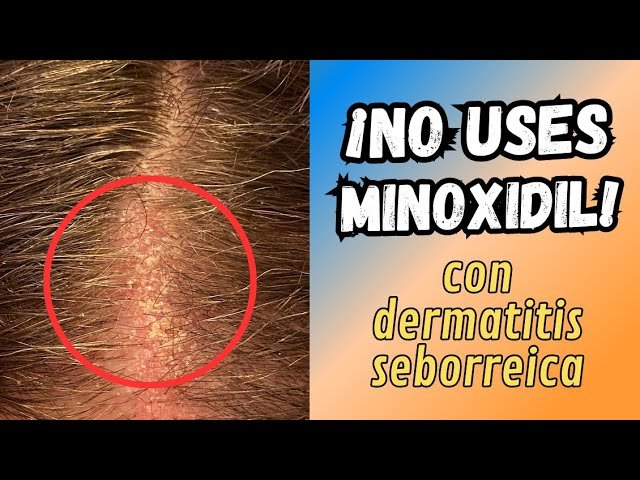 ¿Puedo usar minoxidil si tengo caspa o dermatitis?