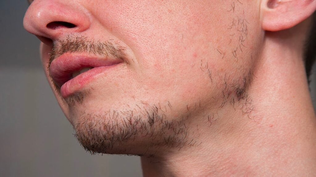Comparte tu historia: cómo lograste una barba en crecimiento más densa