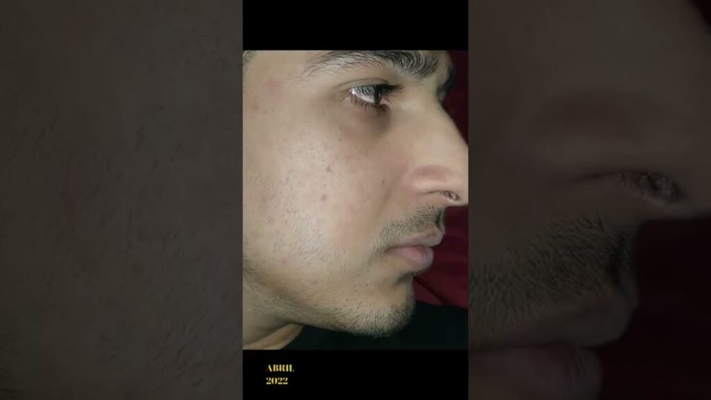 Fotos del antes y después de mi diario personal con minoxidil