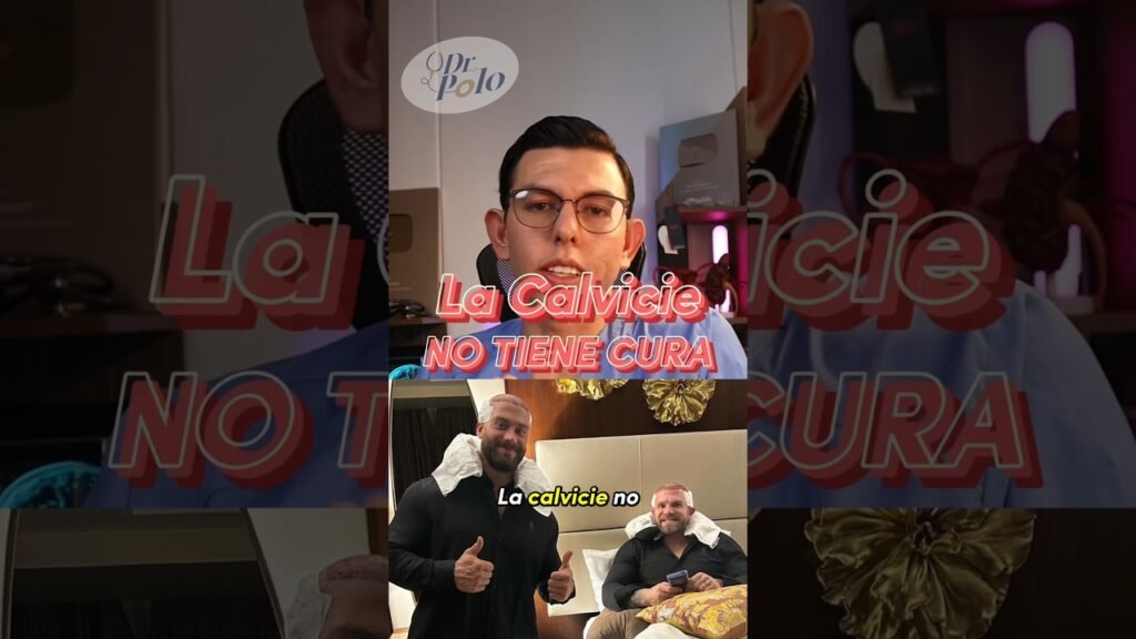 Minoxidil y caída inicial del calvicie hereditaria: lo que necesitas saber