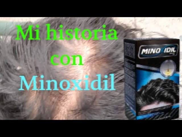 Fotos del antes y después de mi historia inspiradora con minoxidil