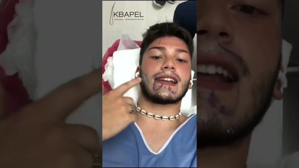 Fotos del antes y después de mi vello facial con minoxidil