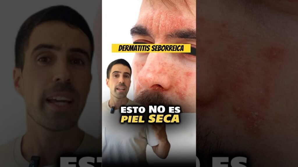 Puedo sufrir alergias graves al usar minoxidil y piel seca en la piel