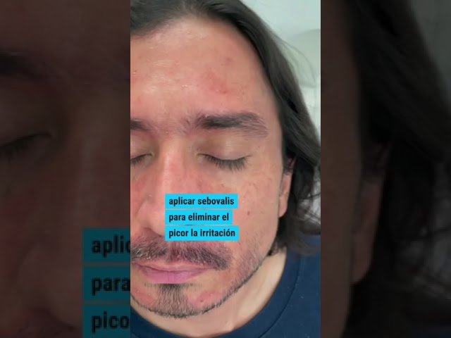 Qué hacer si aparece caspa al usar minoxidil y irritación constante