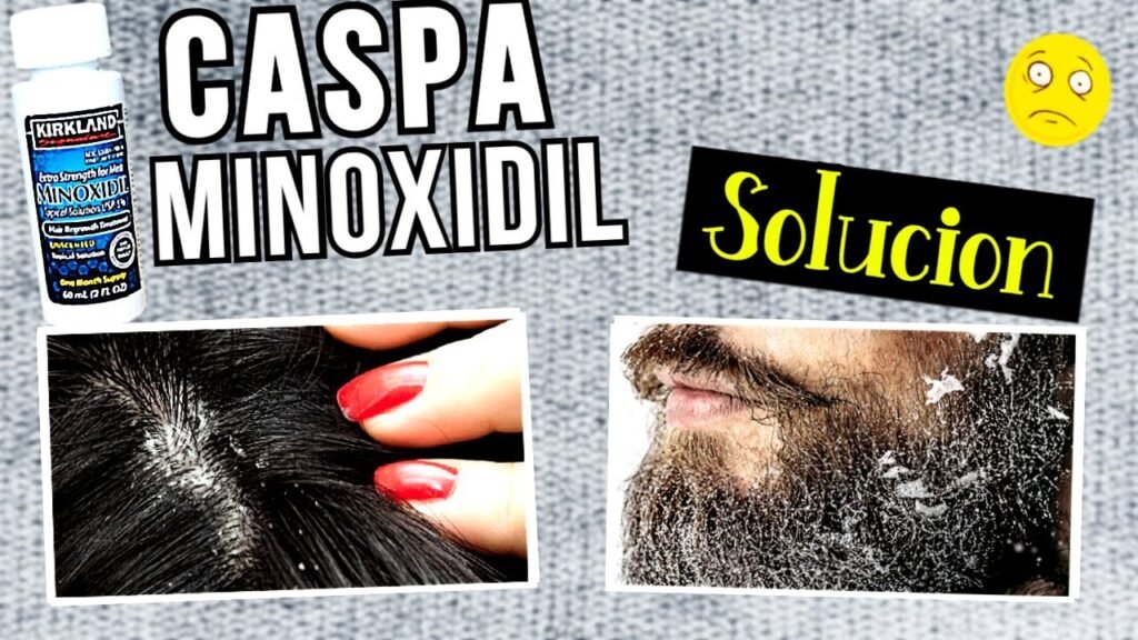 Qué hacer si el minoxidil y sensibilidad extrema provoca descamación de la piel